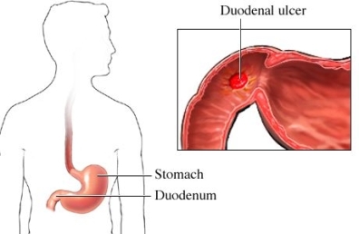 duodenal-ulcer