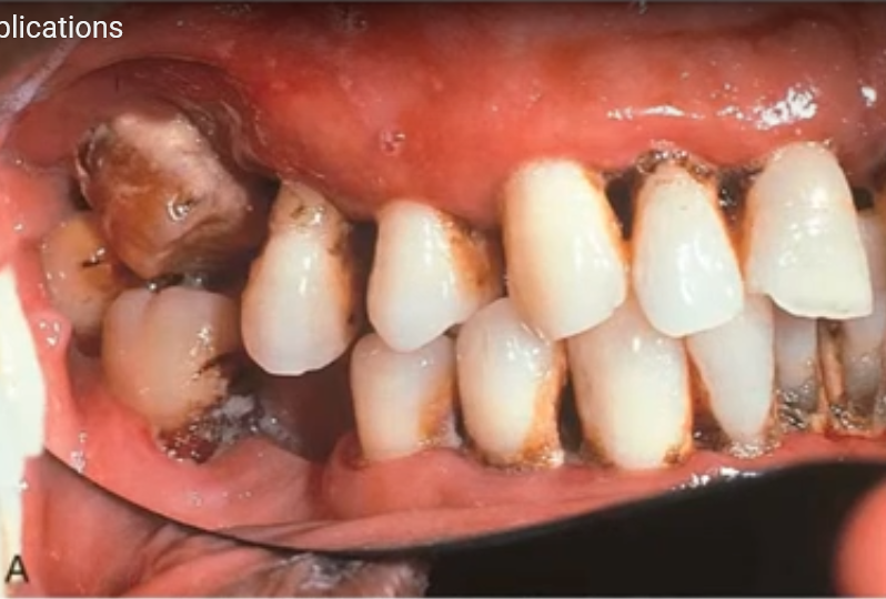  complication of diabetic