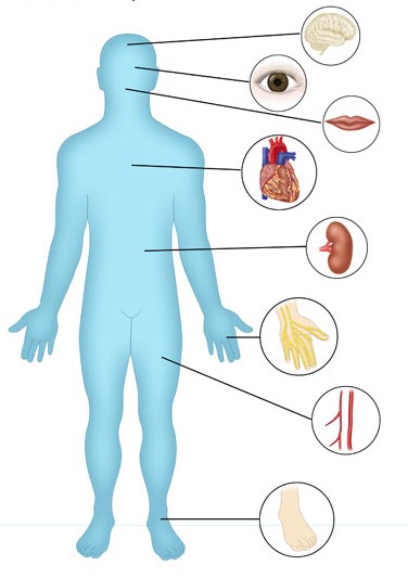 Ketoacidosis