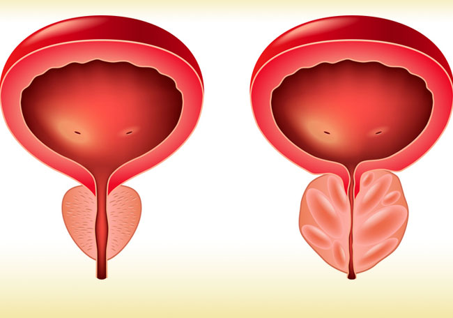 Prostatitis