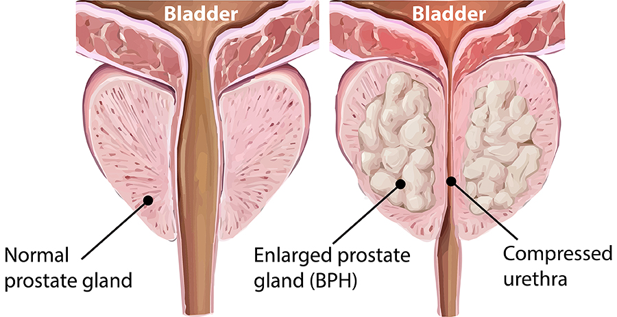 Bening posted hyperplasia (BPH)