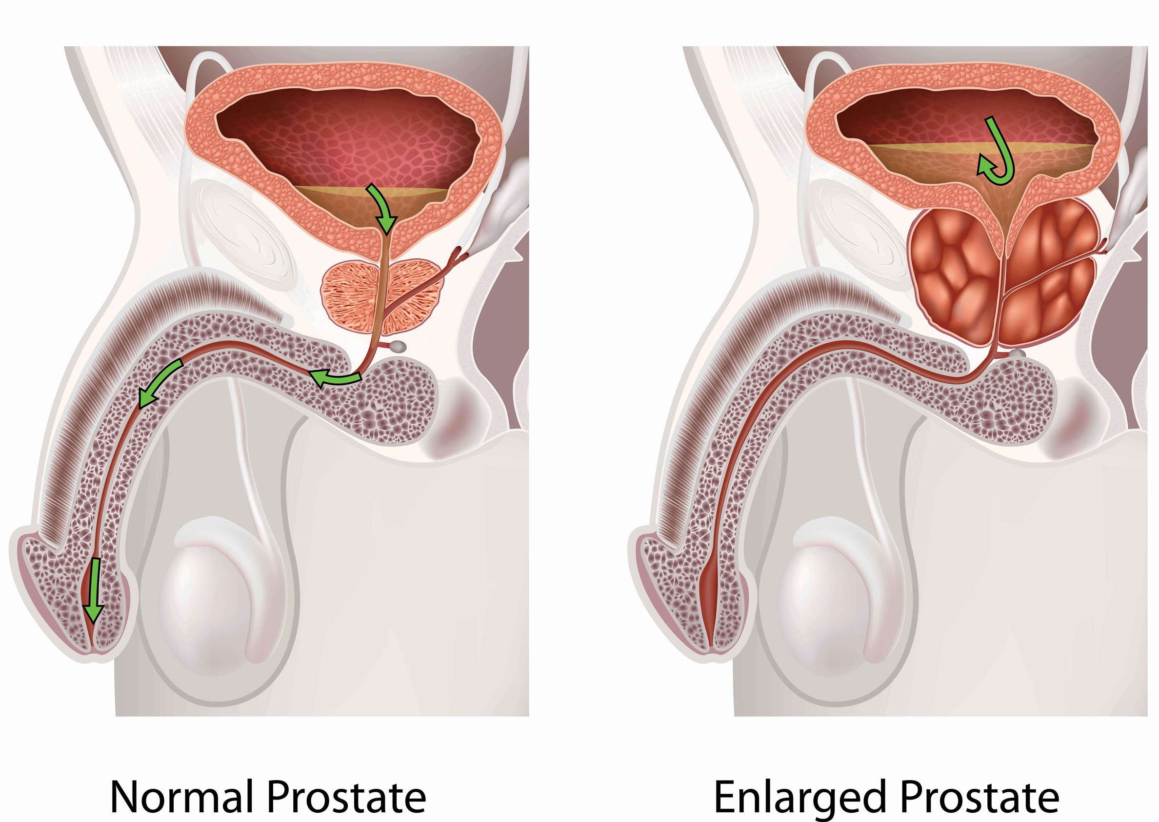 Symptoms of Bening posted hyperplasia (BPH)