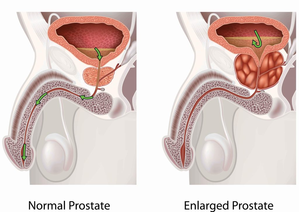 Bening posted hyperplasia (BPH), symptoms and treatment.