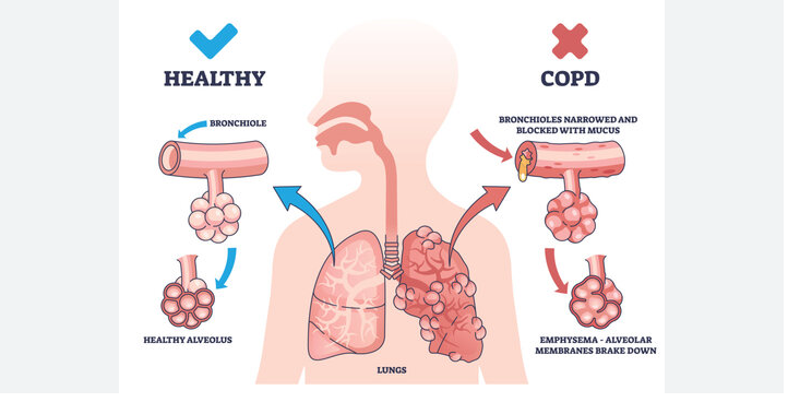 What is Chronic obstructive pulmonary disease (COPD), causes, factors and symptoms.