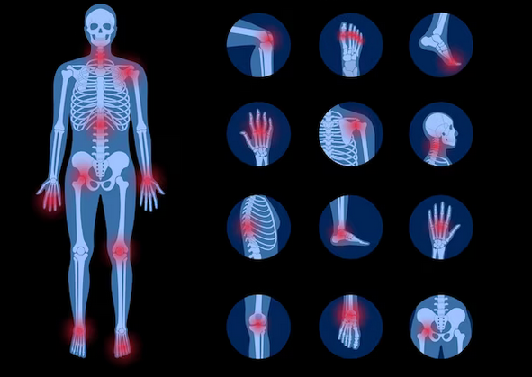 Rheumatoid arthritis symptoms and treatment.