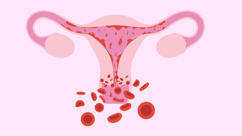 Menorrhagia symptoms and treatment.