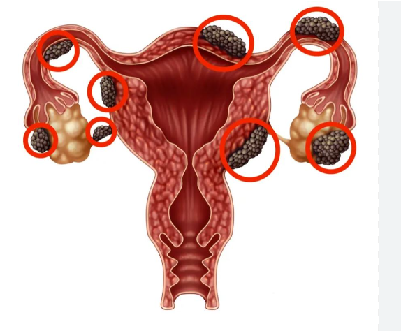 Endometriosis