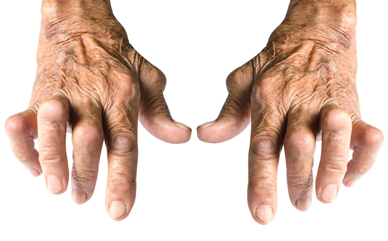 Rheumatoid arthritis (RA)