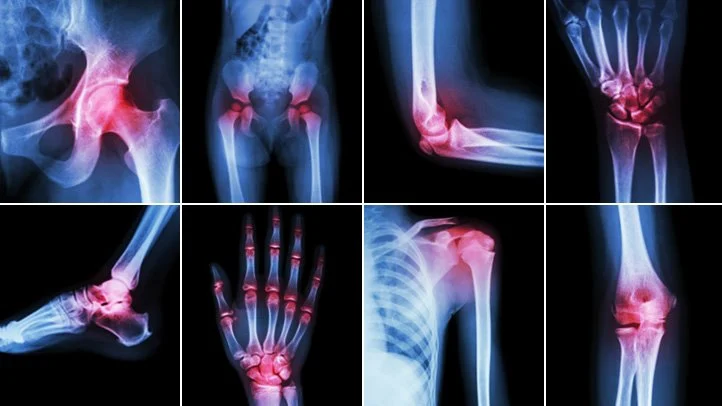 Affected area of Rheumatoid arthritis (RA)