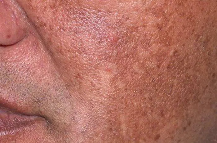 Hyperpigmentation