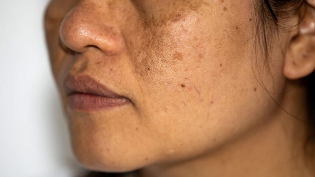 Hyperpigmentation symptoms and treatment